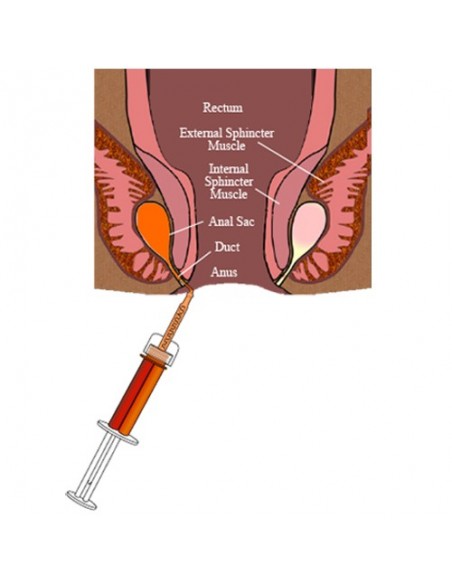 Zestaw do usuwania gruczołów okołoodbytowych